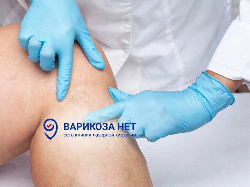 Лечение варикоза в Чебоксарах - Акция до 7 октября!