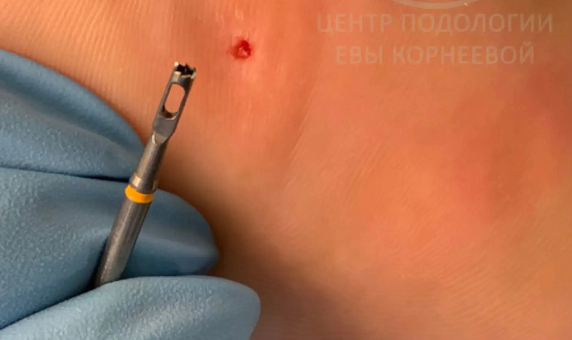 #подология #стержневая