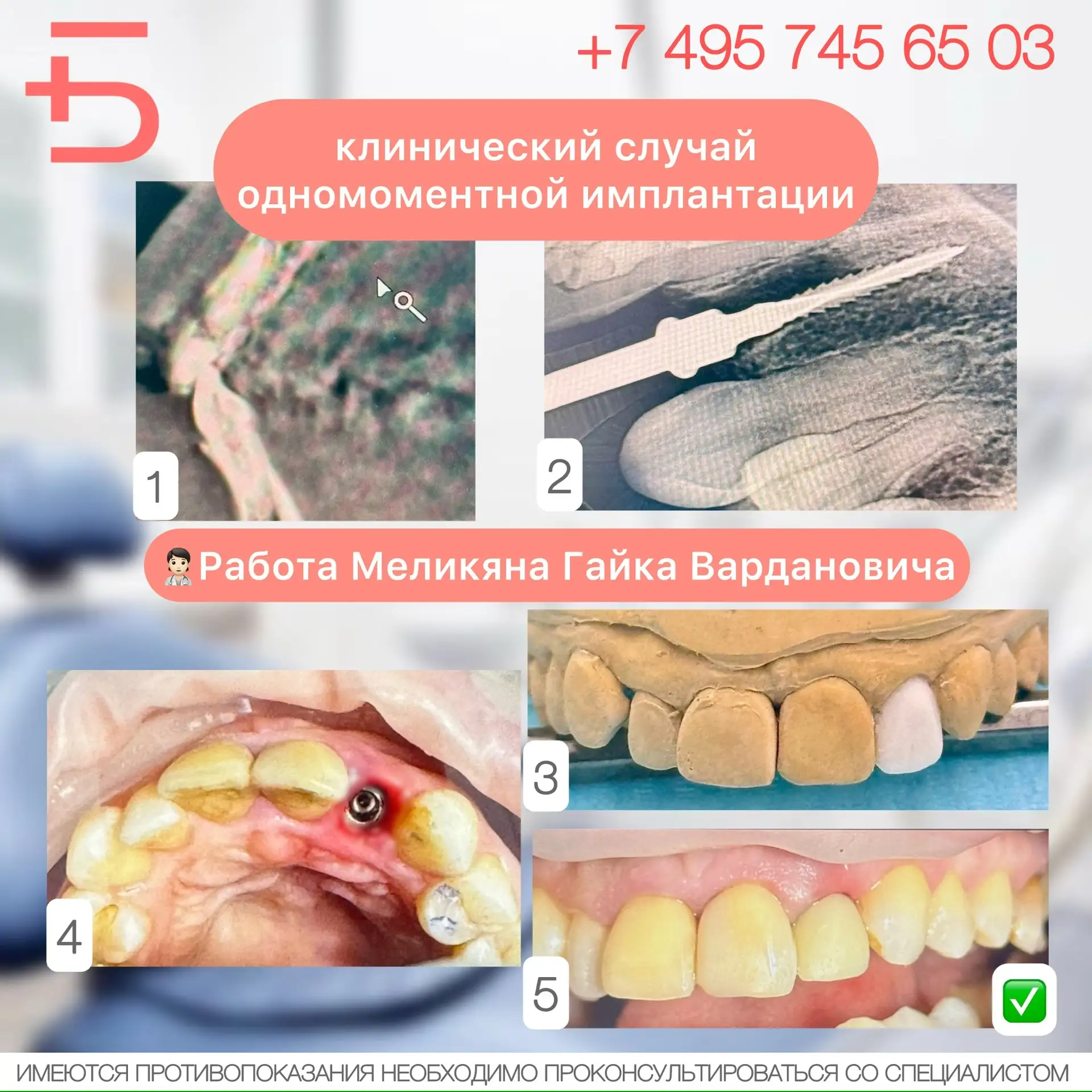 🦷 Недавно к нам обратился пациент, который столкнулся с непростой ситуацией: у пациента был перелом 