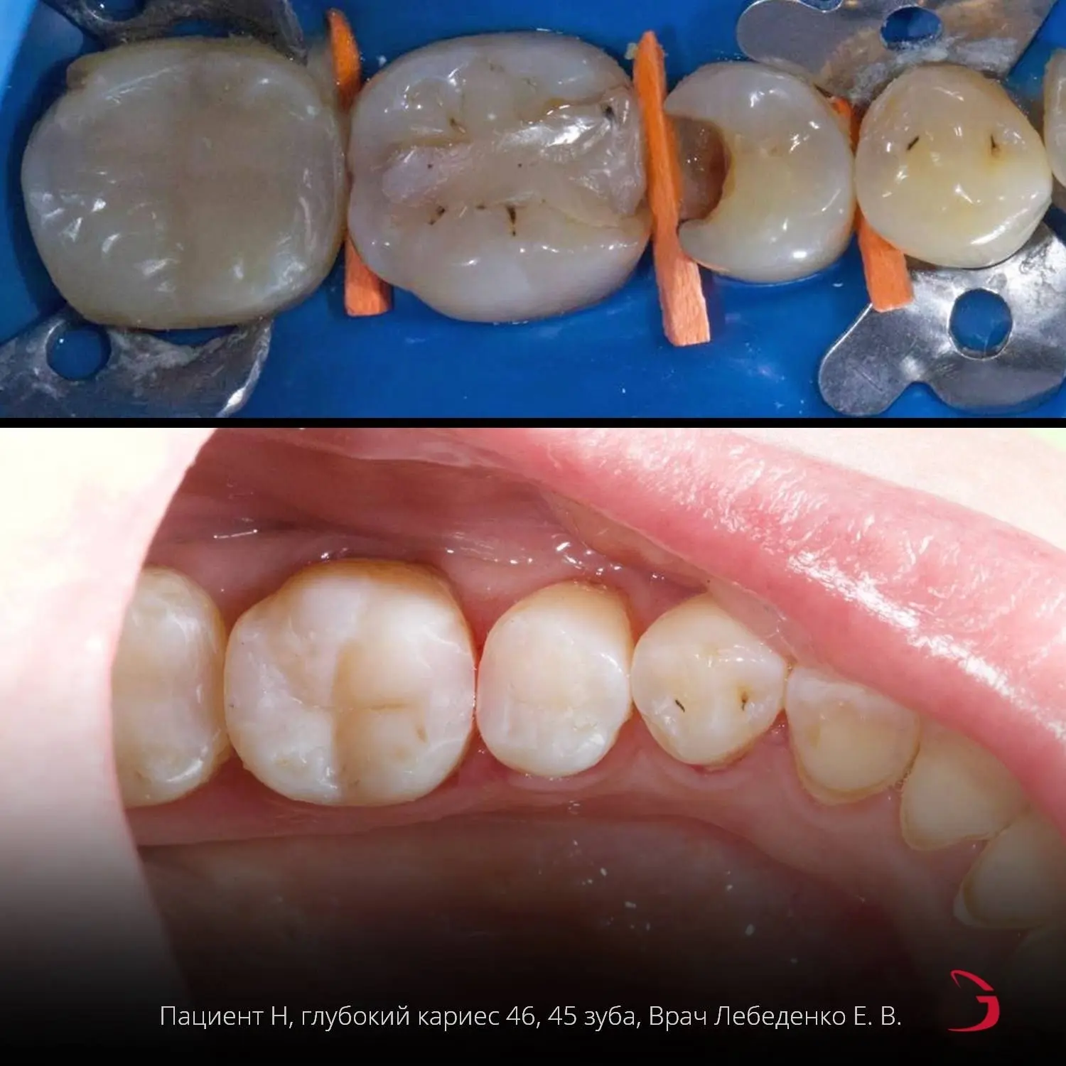 🦷Глубокий кариес —последняя стадия кариеса, при которой поражается большая часть зуба....