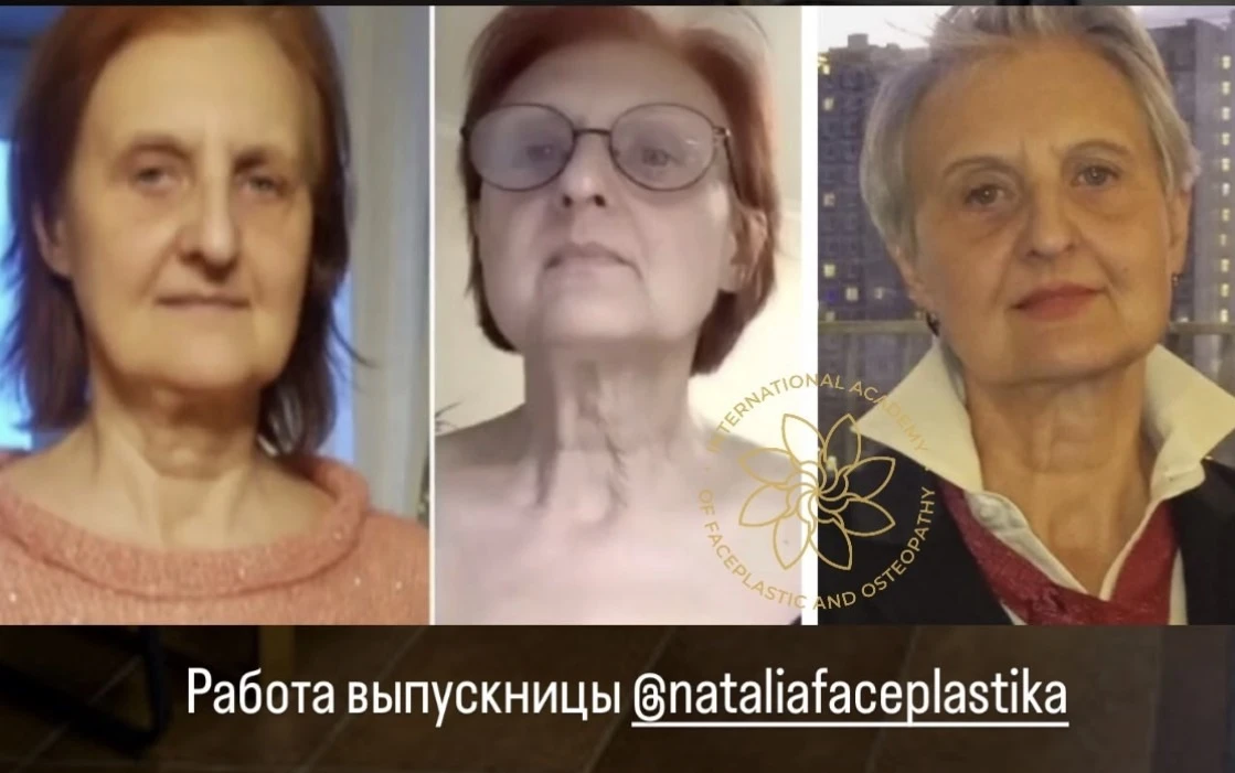 💉 Сейчас уже НЕ модно увеличивать губы!
