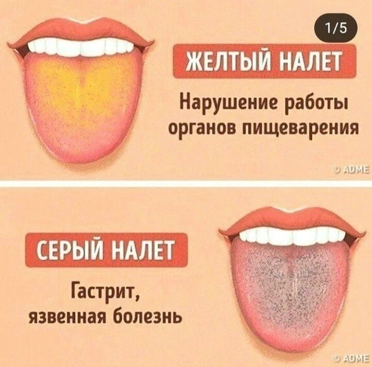 Цвет налета на языке может показать нарушение в работе разных органов.