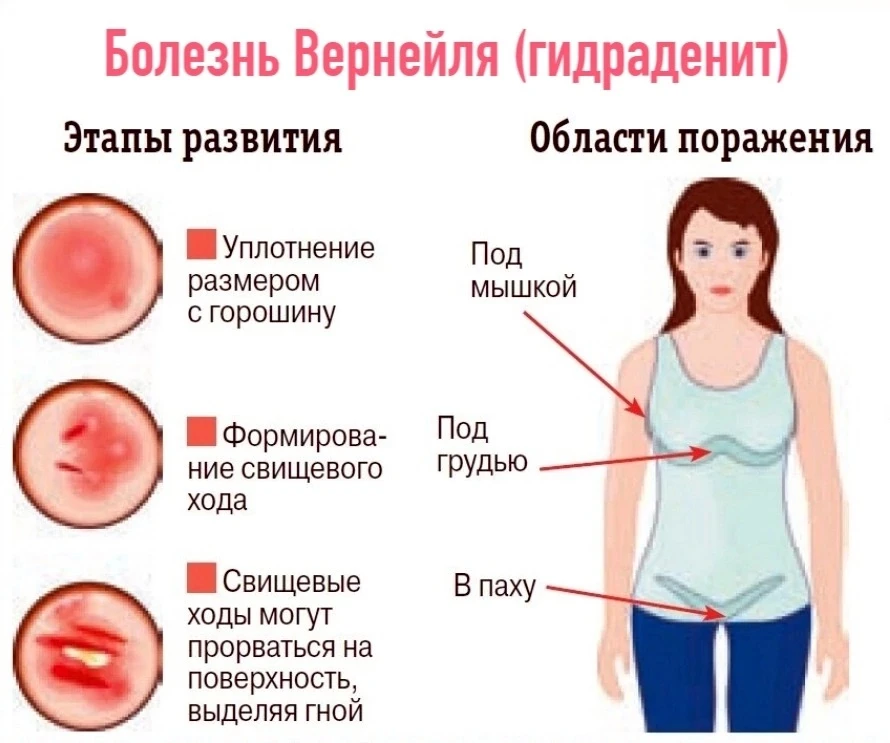 День борьбы с гнойным гидраденитом (ГГ, болезнью Вернейля)!