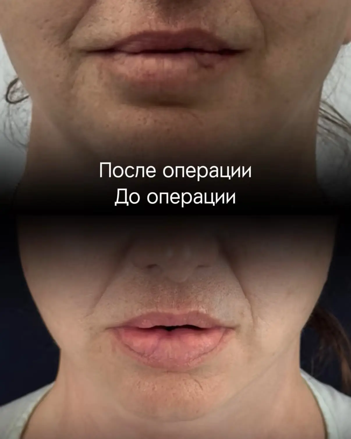 Прошло всего 1,5 месяца после SMAS-подтяжки лица по моей авторской методике и круговой ...