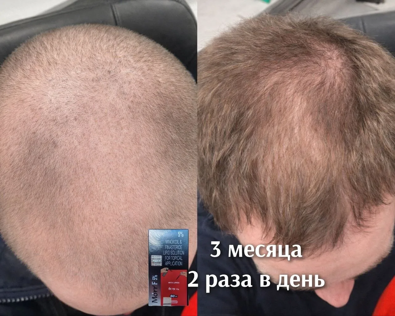 Недавно был пост про удивительное восстановление волос, и на первый взгляд, это похожий...