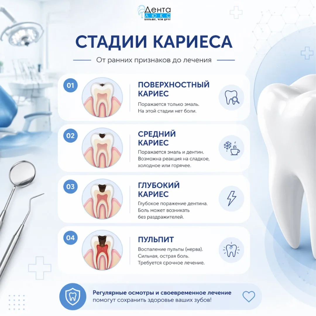 4 стадии кариеса: как вовремя 🔎 распознать проблему?