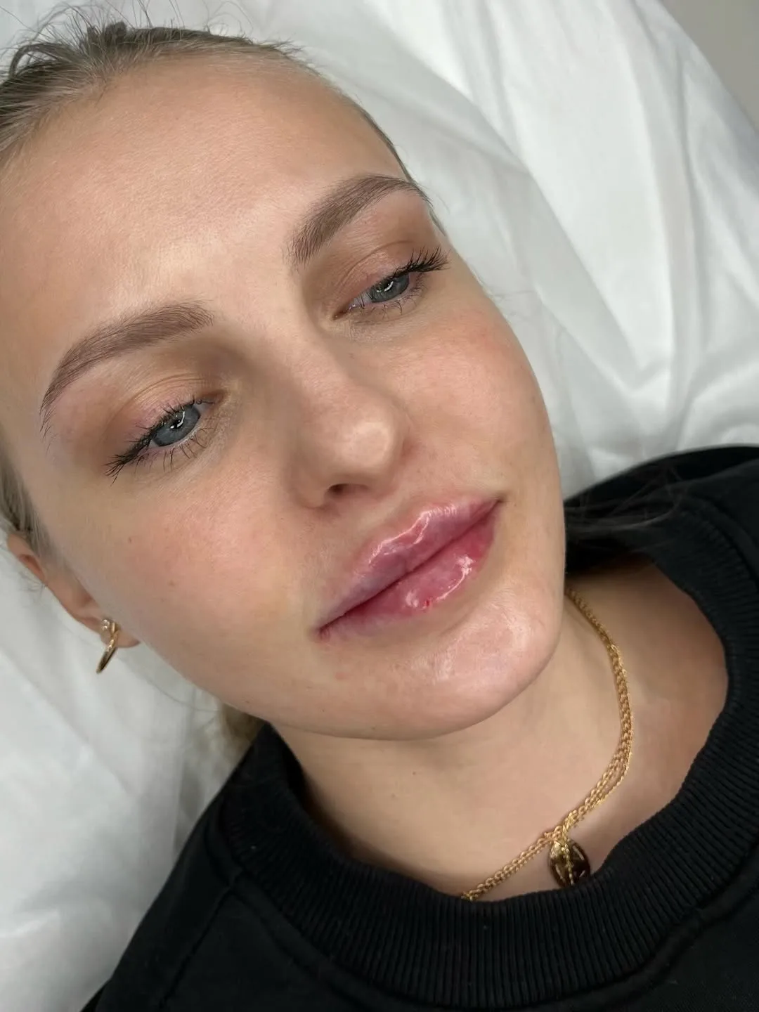 Аугментация губ 👄🌸