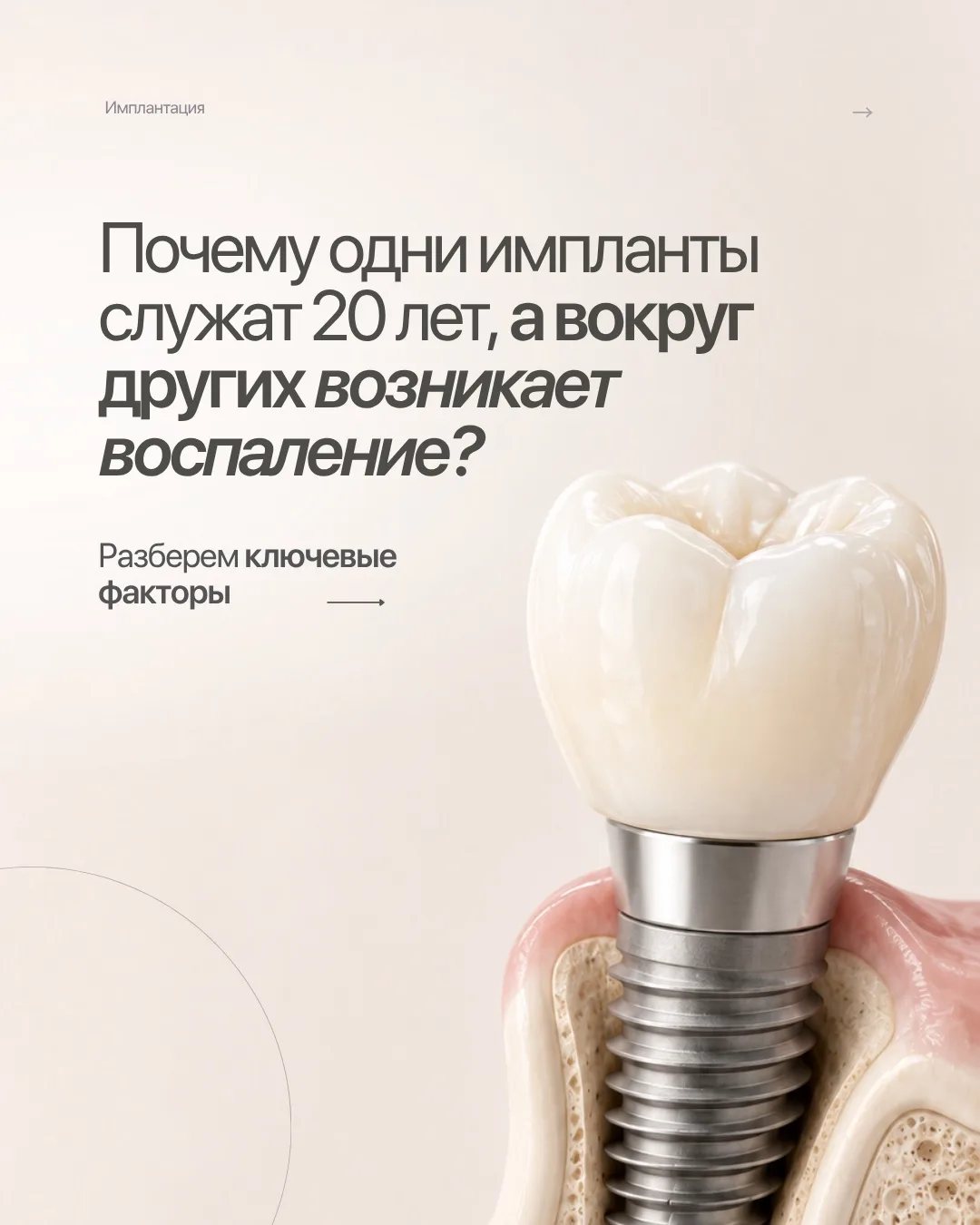 📌 ПОЧЕМУ ОДНИ ИМПЛАНТЫ СЛУЖАТ 20 ЛЕТ, А ВОКРУГ ДРУГИХ ВОЗНИКАЕТ ВОСПАЛЕНИЕ?