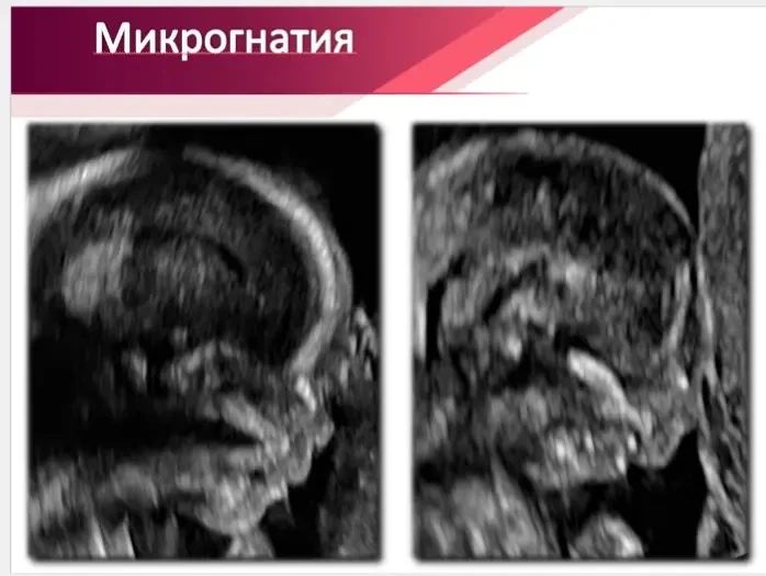 Микрогнатия является одним из самых спорных определений в пренатальной диагностике поскольку, несмот
