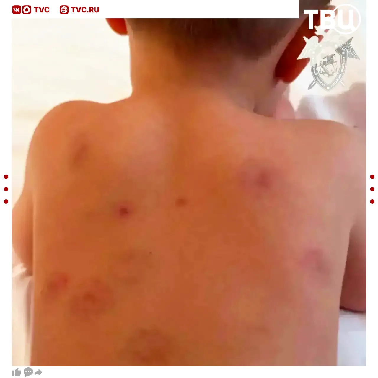 Шестнадцать укусов обнаружили родители на теле двухлетнего мальчика после детсада   Никто из сотрудн