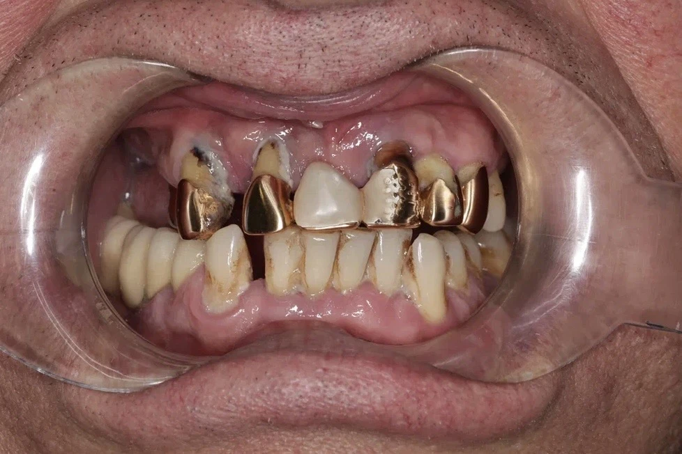 🦷 ДО/ПОСЛЕ. Восстановили все зубы сразу за 3 дня!   Пациент обратился в клинику с критическим состоя