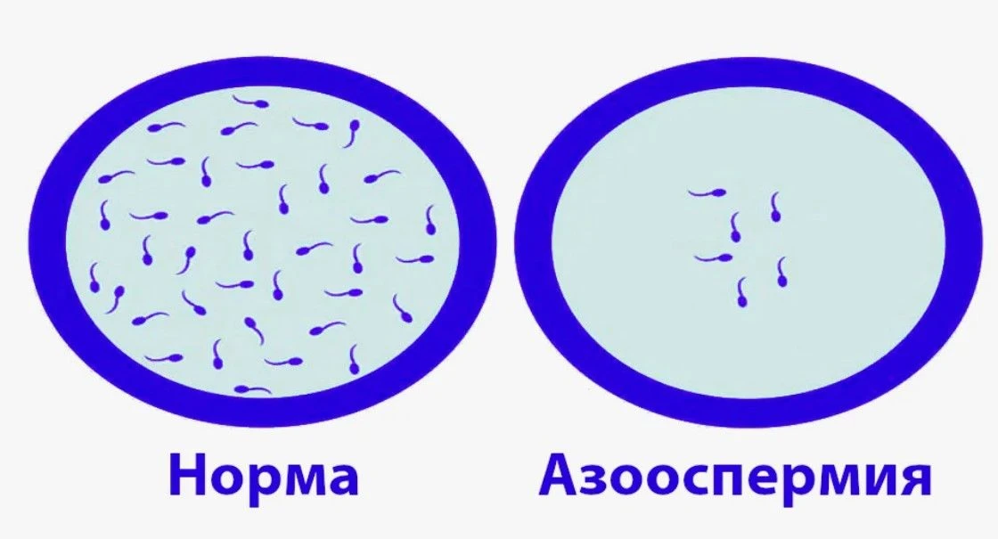 Важно: Диагноз «Азооспермия» — не приговор!
⁣
Первое и самое главное: диагностику и лечение должен п