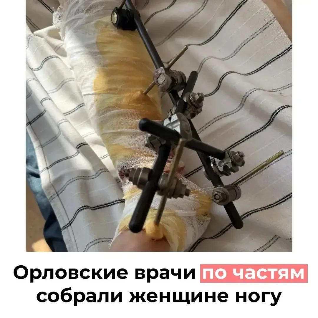 🚑 Орловские врачи спасли женщине ногу после серьёзной травмы триммером