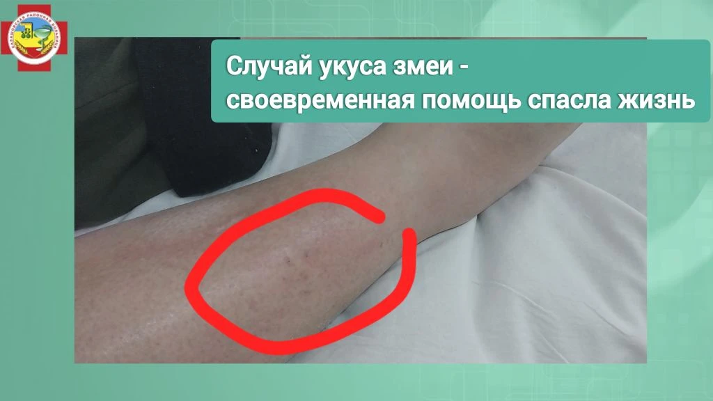 В нашу больницу поступила пациентка после укуса змеи. Женщина занималась огородными работами - сажал