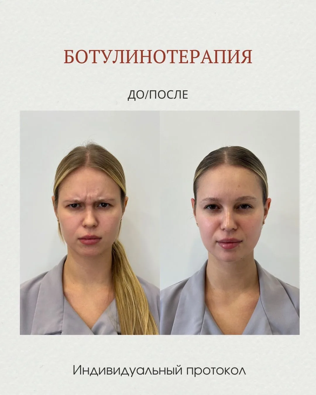 Свежий и отдохнувший вид без эффекта «переколотого» лица — именно за это любят ботулино...