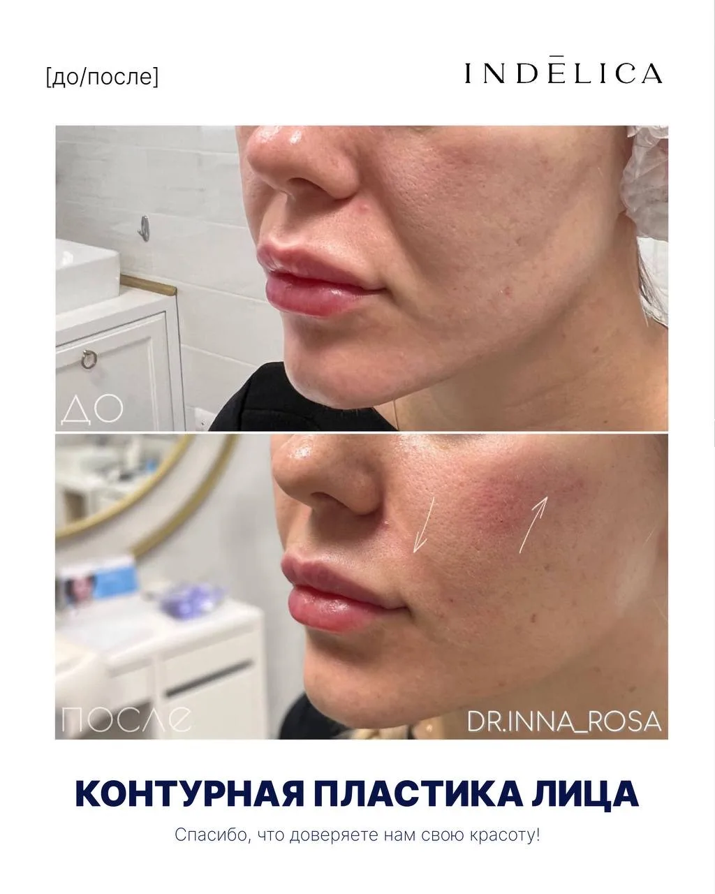 Вы боитесь филлеров — потому что видели, как бывает «не так». Мы тоже видели. Поэтому р...