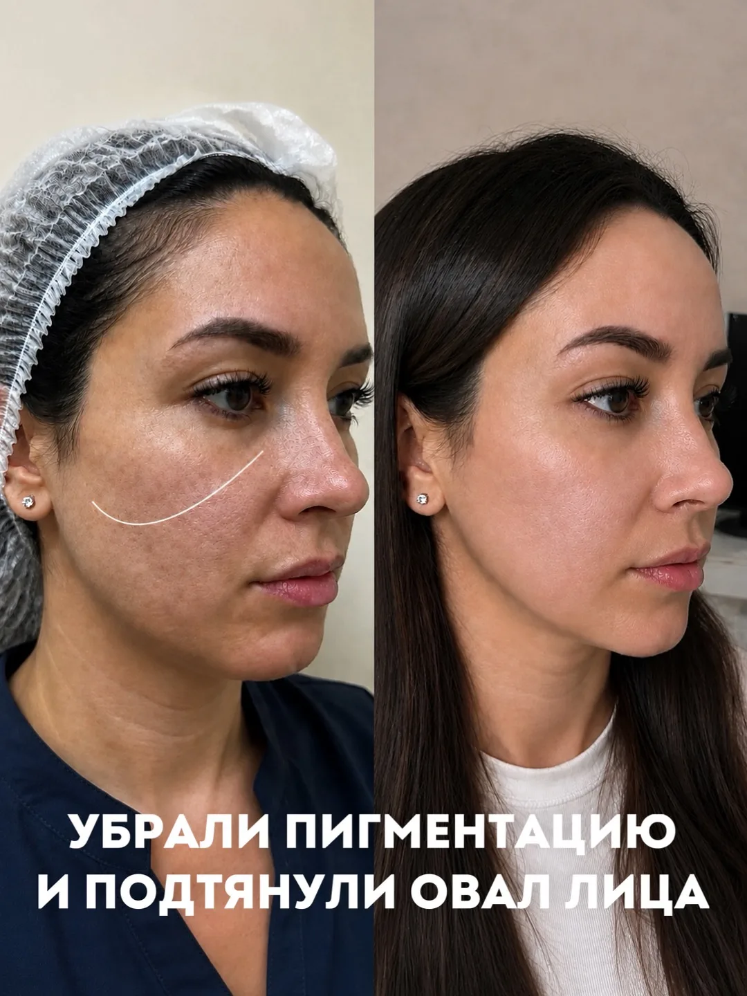УБРАЛИ ПИГМЕНТАЦИЮ И СДЕЛАЛИ ОВАЛ ЛИЦА ЧЁТЧЕ 🔥