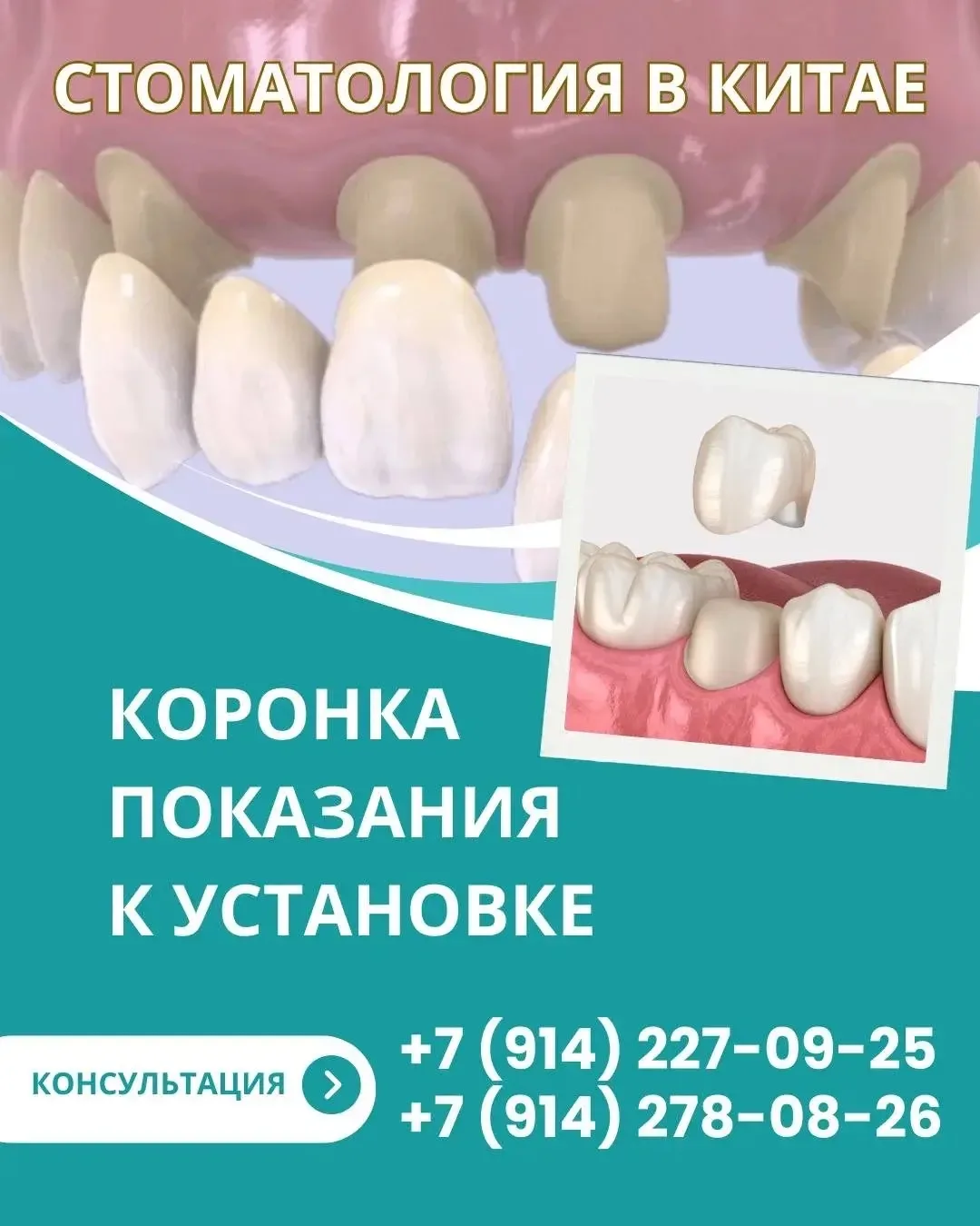 Зубная коронка — это несъёмная ортопедическая конструкция, которая полностью покрывает ...