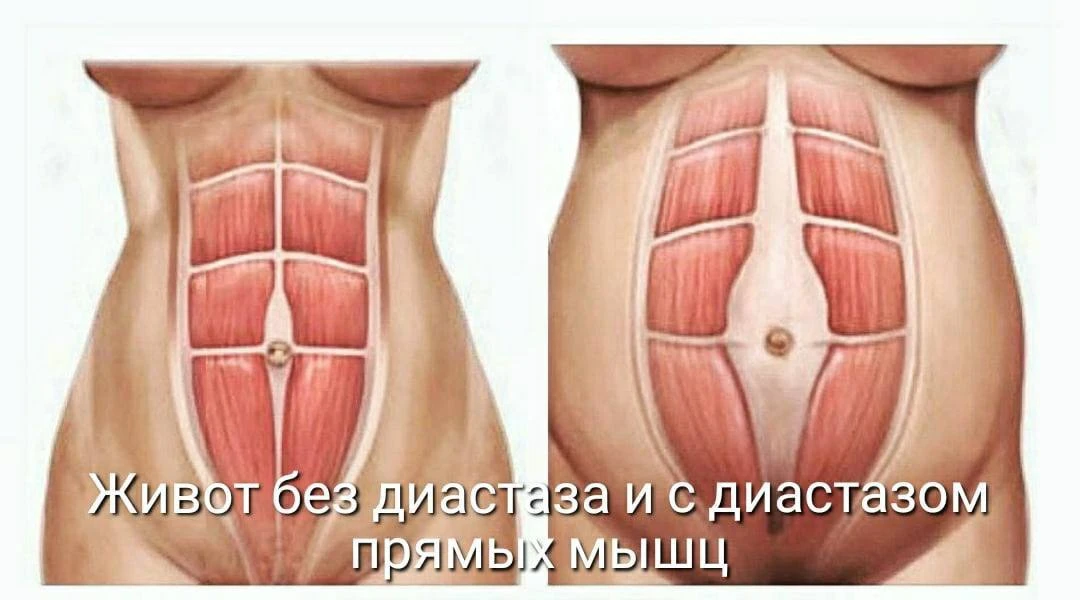 Настолько сильный диастаз после двух родов был, что просто вываливался живот и органы.