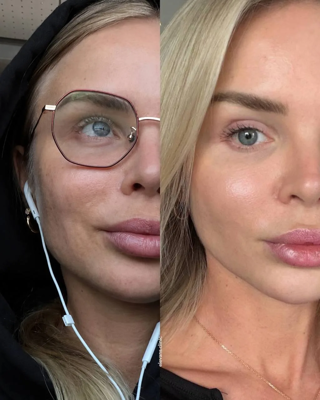 Результат нашей пациентки за несколько месяцев 😍

Чтобы добиться такого выраженного, но при этом ес