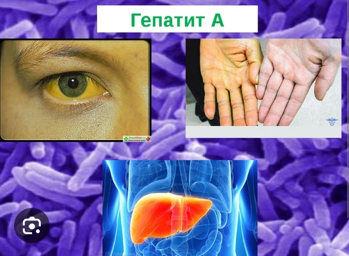 👉  Гепатит А (его ещё называют болезнью Боткина) — это острое инфекционное заболевание, при котором