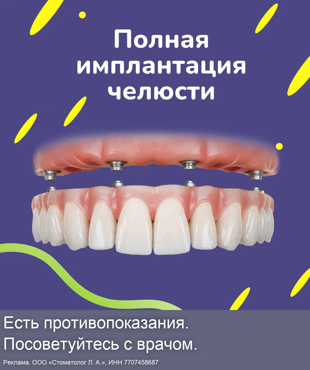 Протезирование зубов на 4-х имплантах по выгодной цене!