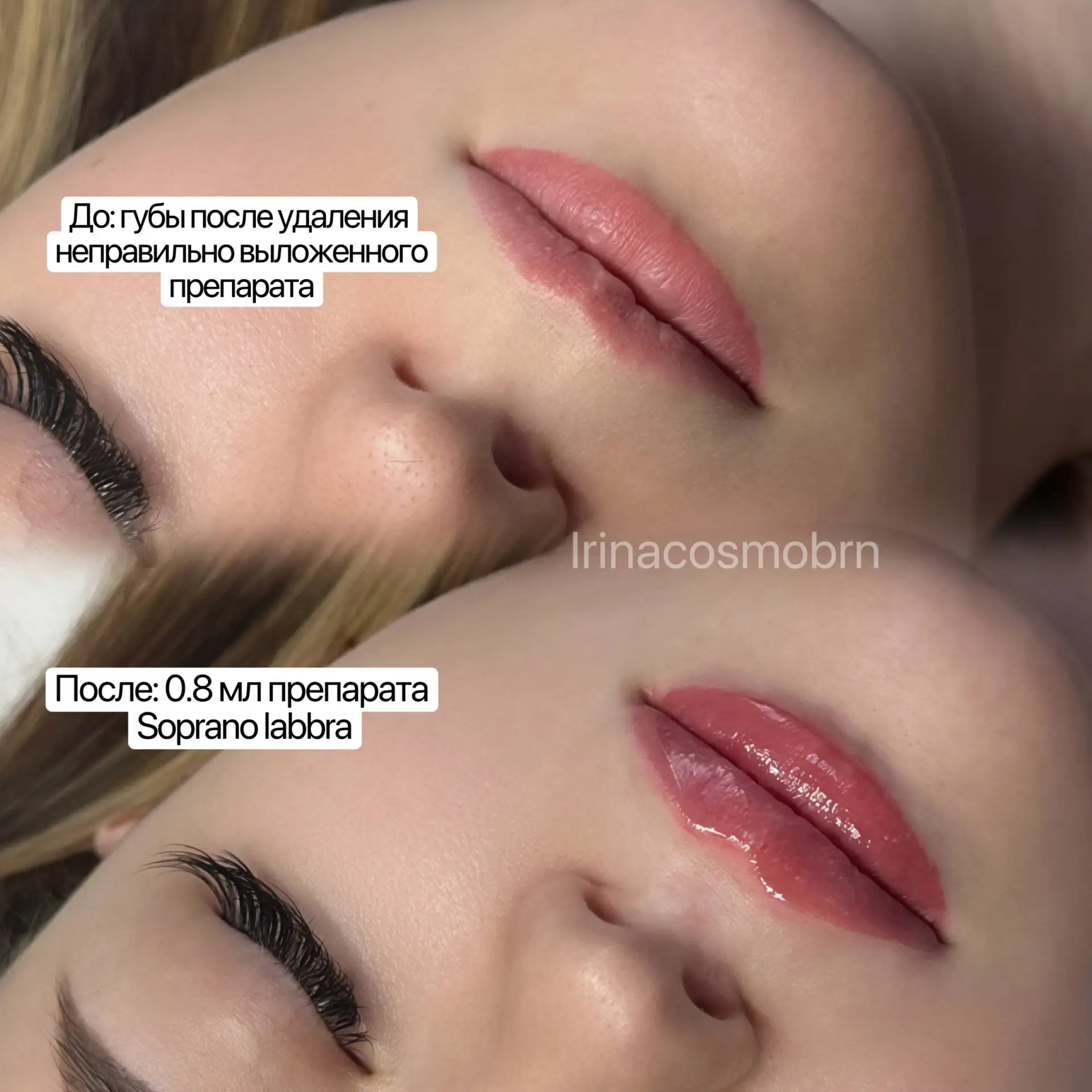 Soprano Labbra — препарат, который часто беру в работу на сложные губы. Особенно после ...