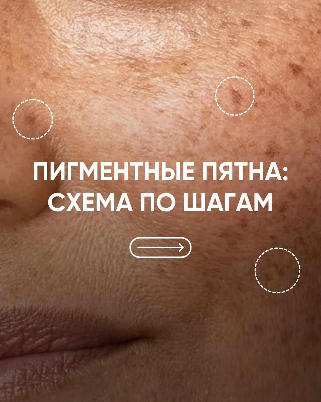 Стираем пигментные пятна: пошаговая схема ухода ✏️

Пигментация — одна из самых сложных задач в уход