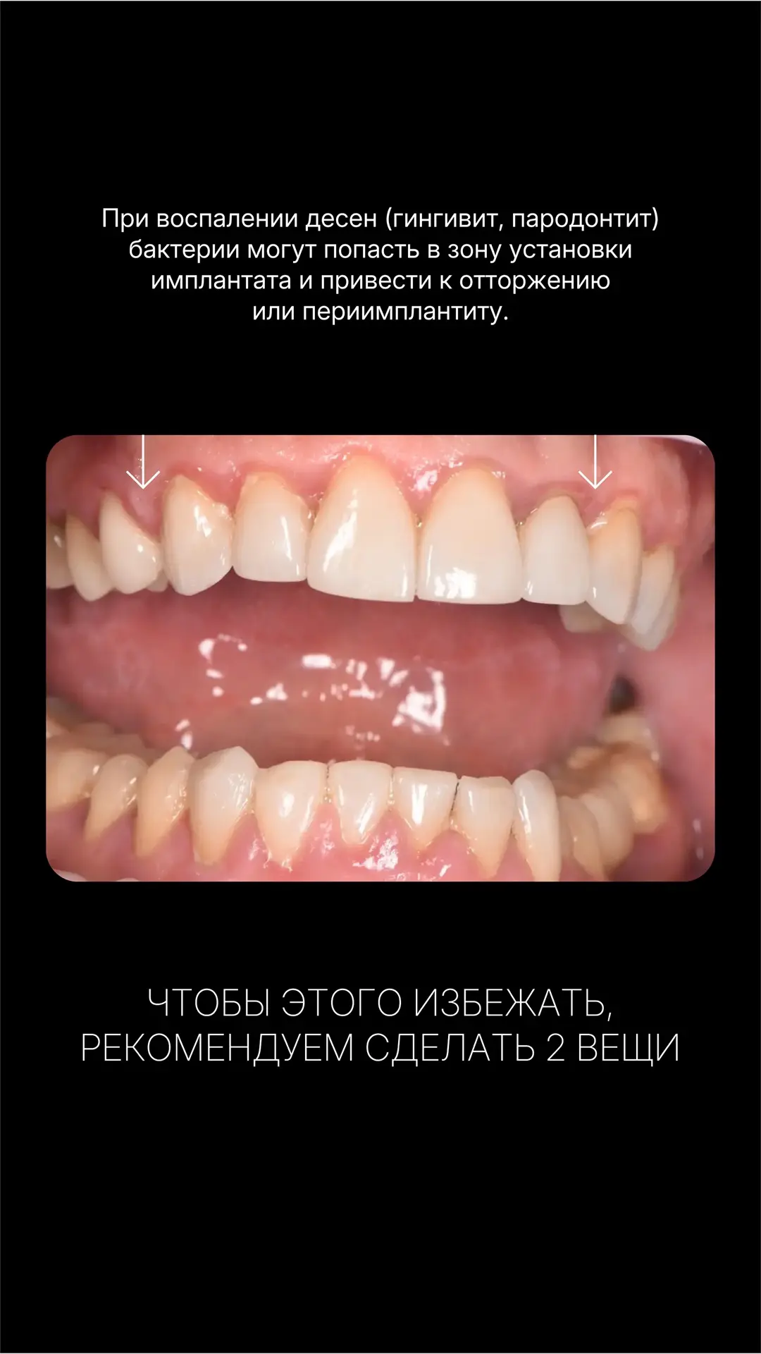 Можно ли ставить имплантаты, если дёсны воспалены?