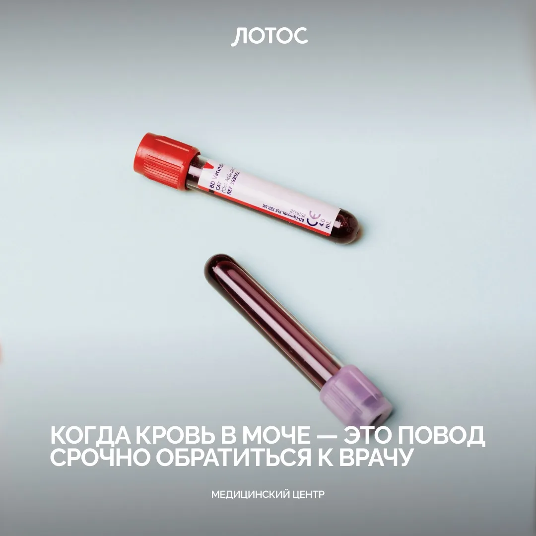 Даже если кровь в моче появилась всего один раз и больше не повторялась, откладывать ви...