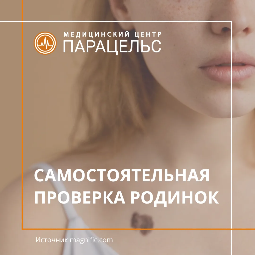 Как понять, какая родинка может стать меланомой?