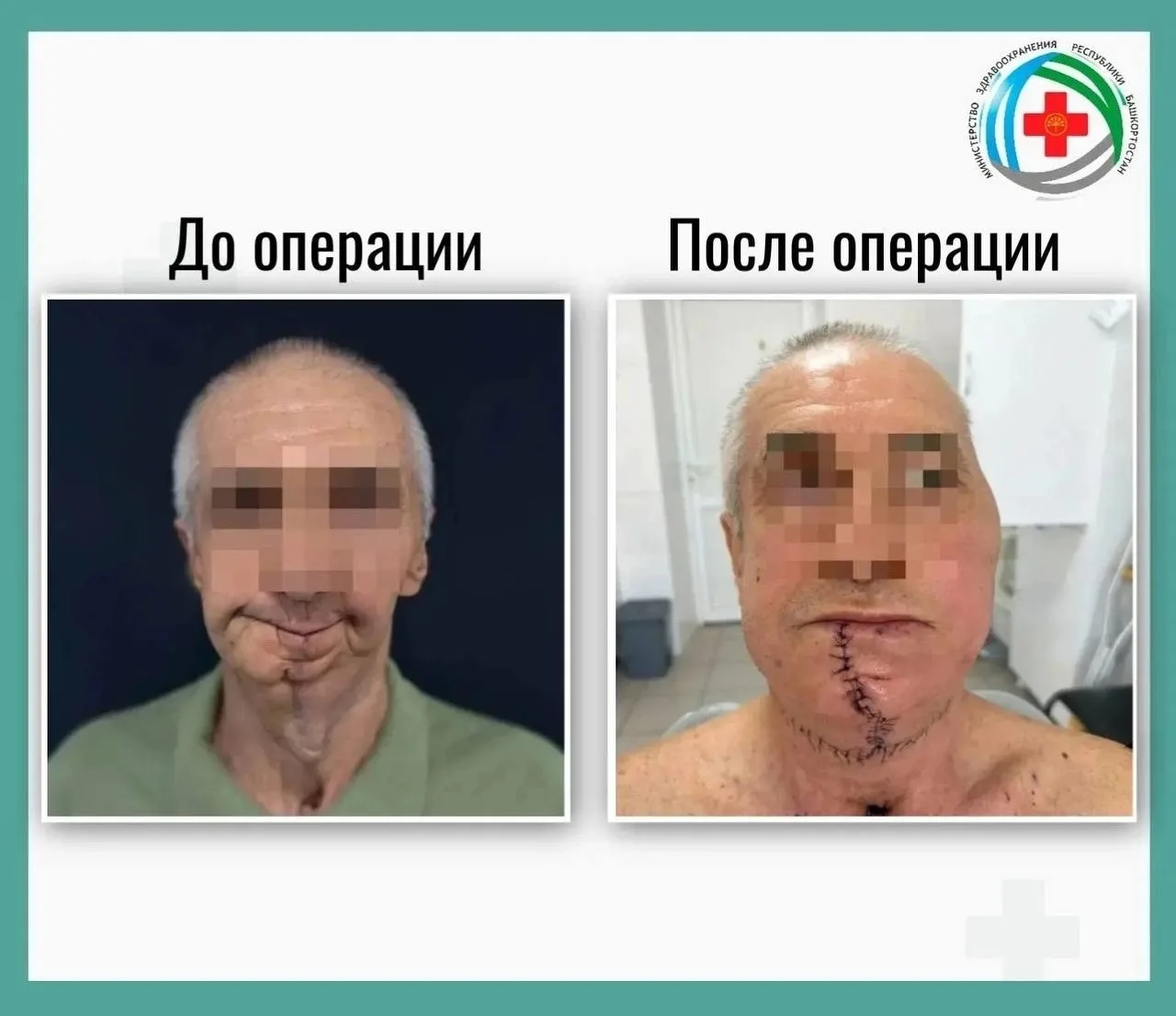 😱В Башкирии пациенту полностью восстановили челюсть после удаления рака