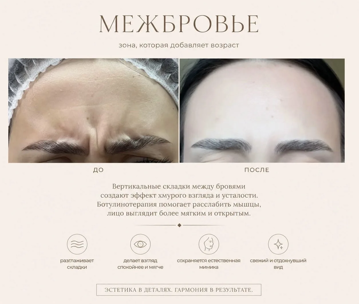 Ботулинотерапия 🫶🏻