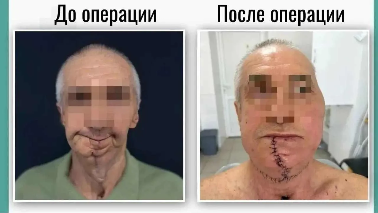 В Башкирии врачи восстановили челюсть пациенту с онкологией