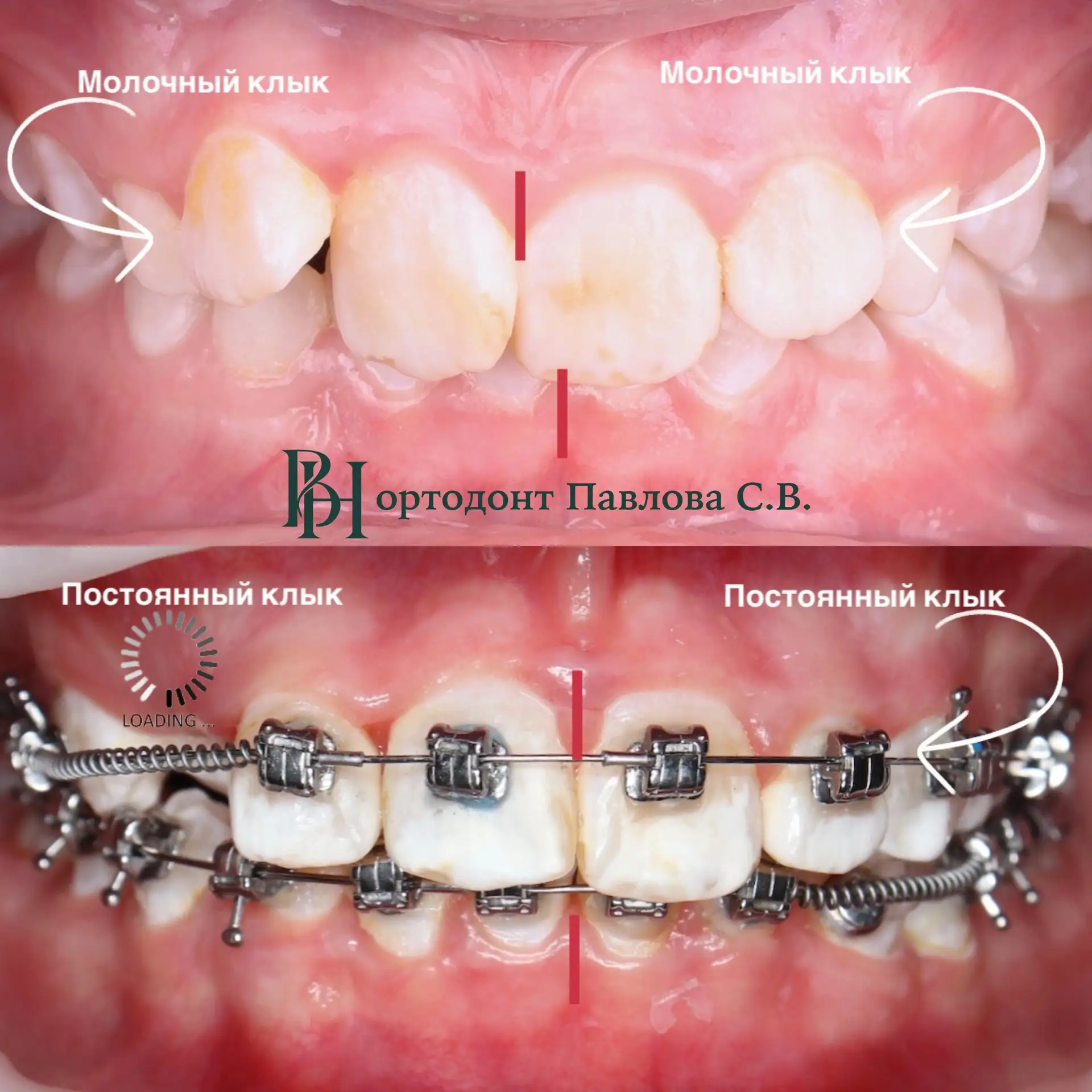 🦷 Кейс из практики ортодонта Павловой С.В.