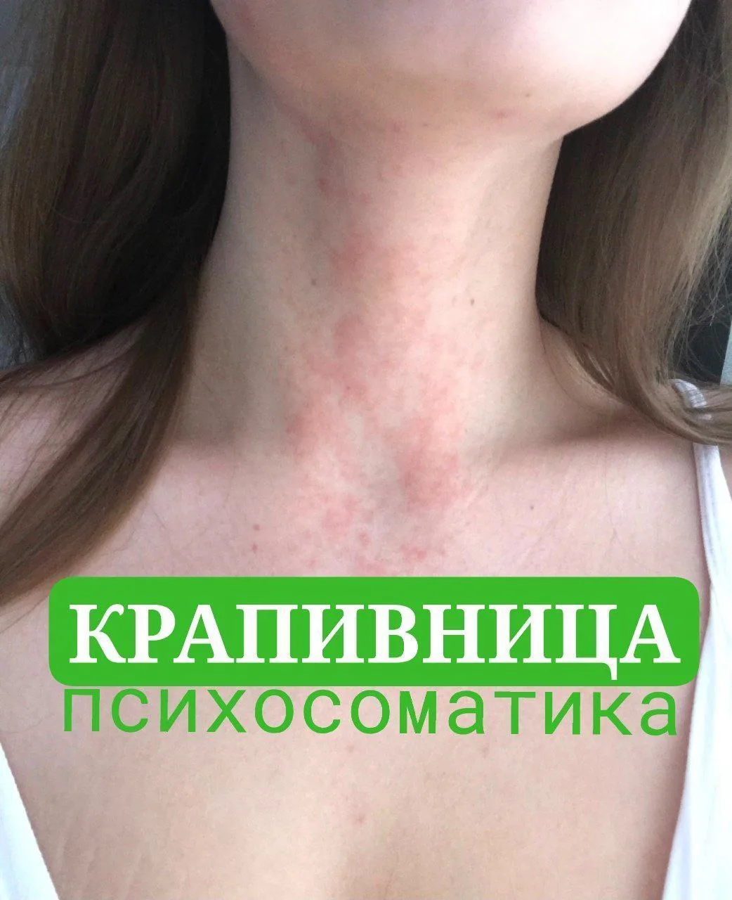 ❓Добрый день, появилась крапивница в районе шеи и жжет, на море появилось в апреле, ран...