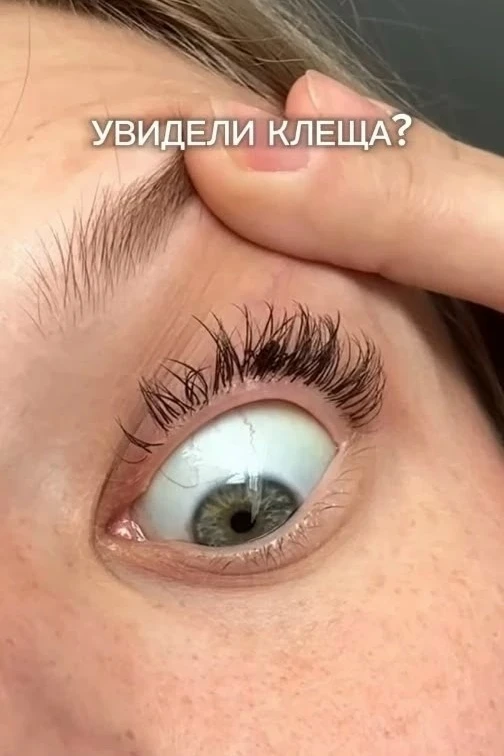 🕷 Почти целые сутки девушка ходила с живым клещом, который поселился между её ресницами.  26-летняя 