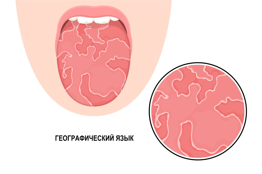 Женщина, 41 год.   Пришла с жалобой: язык печёт, края красные, вкус еды стал резким. Обследовали жел