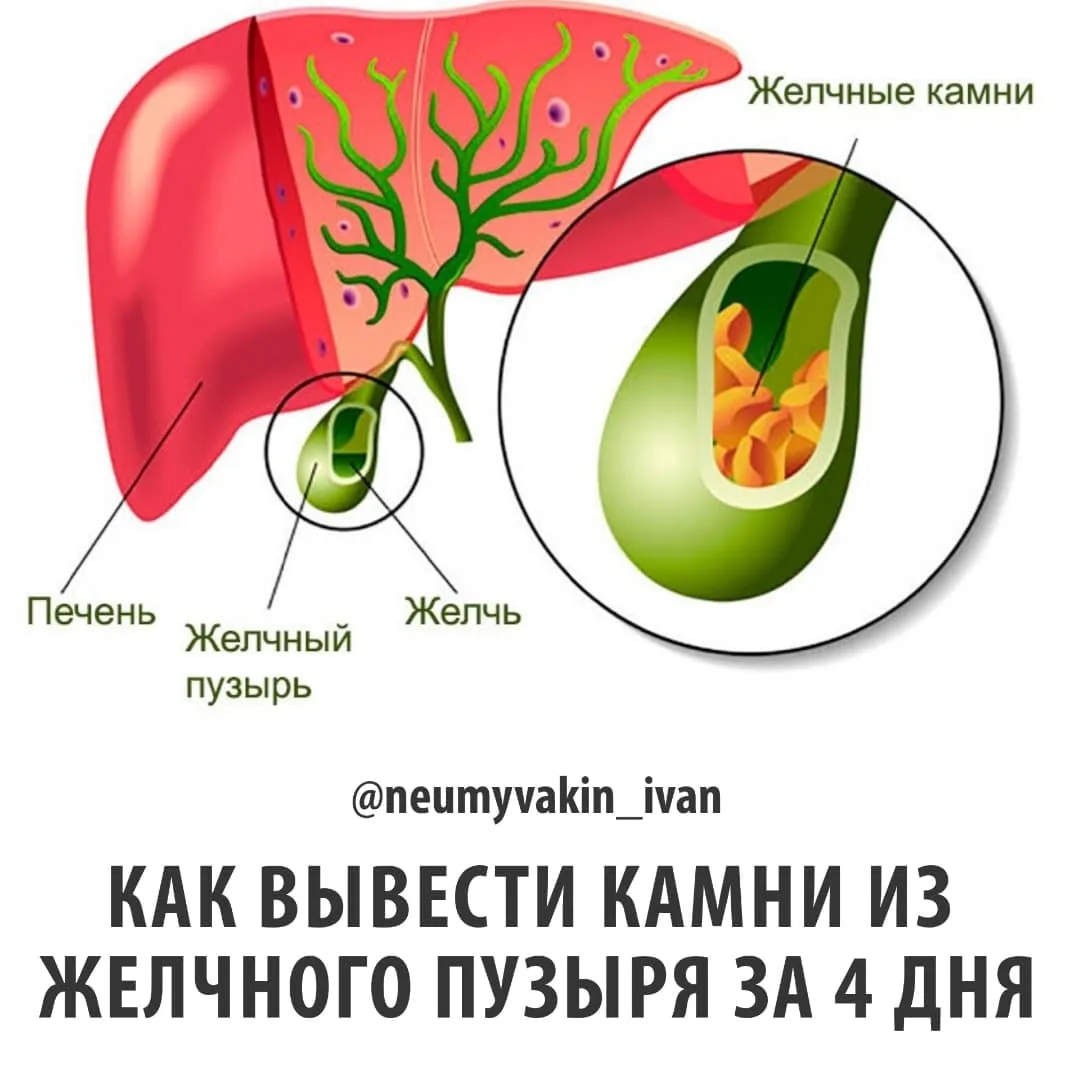 ✳🌼ВЫВЕДЕНИЕ КАМНЕЙ ИЗ ЖЕЛЧНОГО ПУЗЫРЯ - ПРОЦЕДУРА, КОТОРАЯ
ПРАКТИКУЕТСЯ ЕЩЁ С ДРЕВНИХ ВРЕМЁН
МНОГИМ