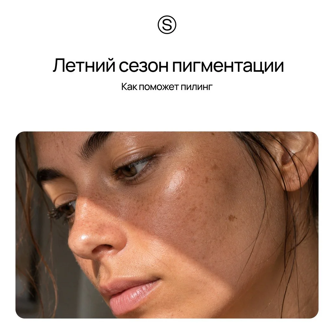 Как косметолог понимает, что наступило лето? Клиенты начинают приходить со свежей пигментацией после