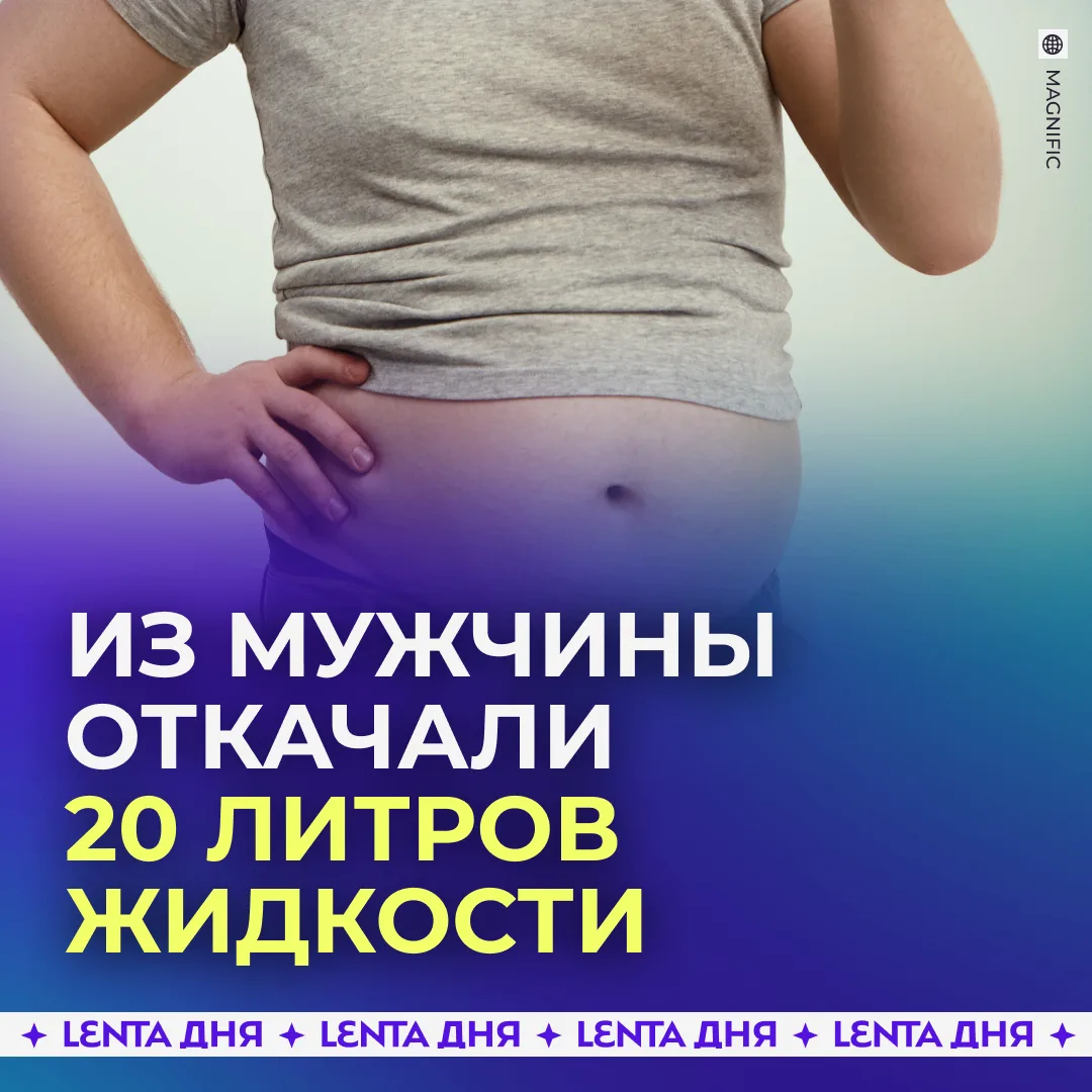 👨‍🦰 Россиянин принял 20 литров отёков за «пивной живот» и попал в реанимацию.