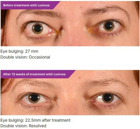 👁ЭОП больше не терапия одного препарата: FDA одобрило велигротуг