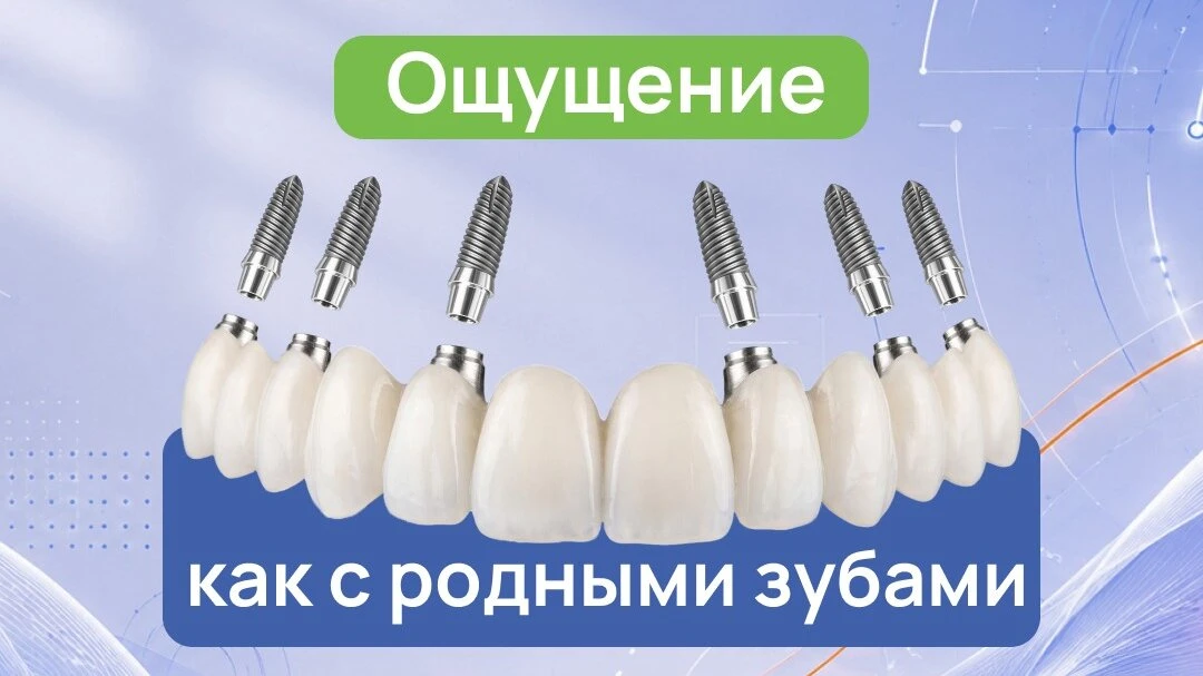 Имплантация зубов нового поколения — протез без десны!