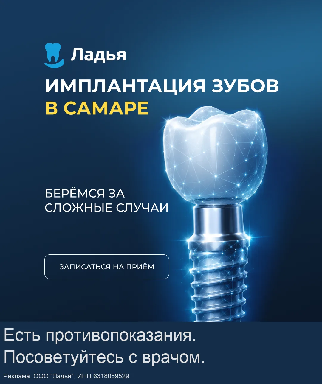 Имплантация зубов за 1 день в Самаре. Приём бесплатно!