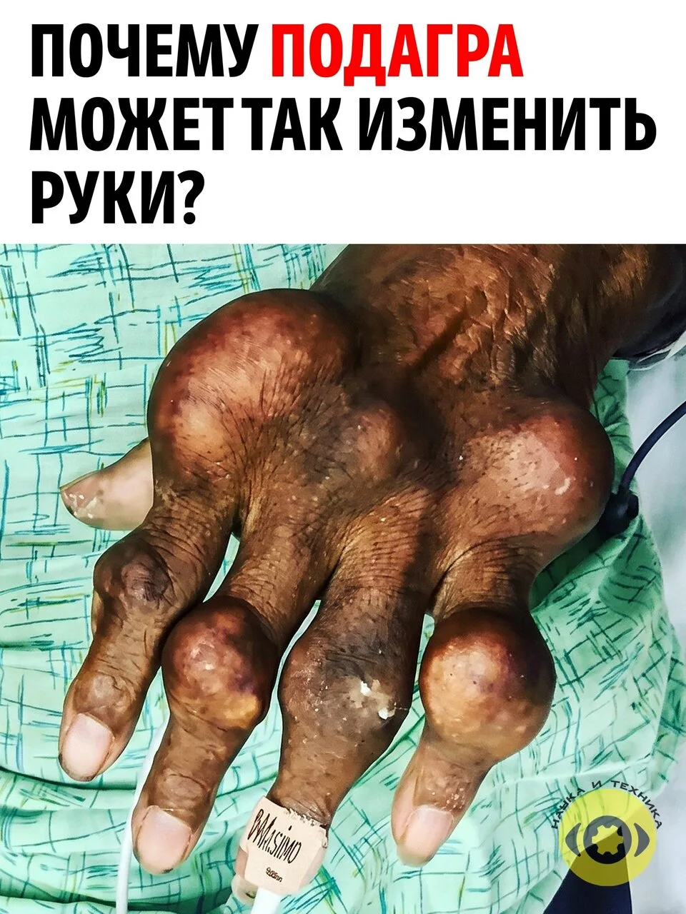 На фотографии видны огромные плотные образования вокруг суставов пальцев. Это тофусы, к...