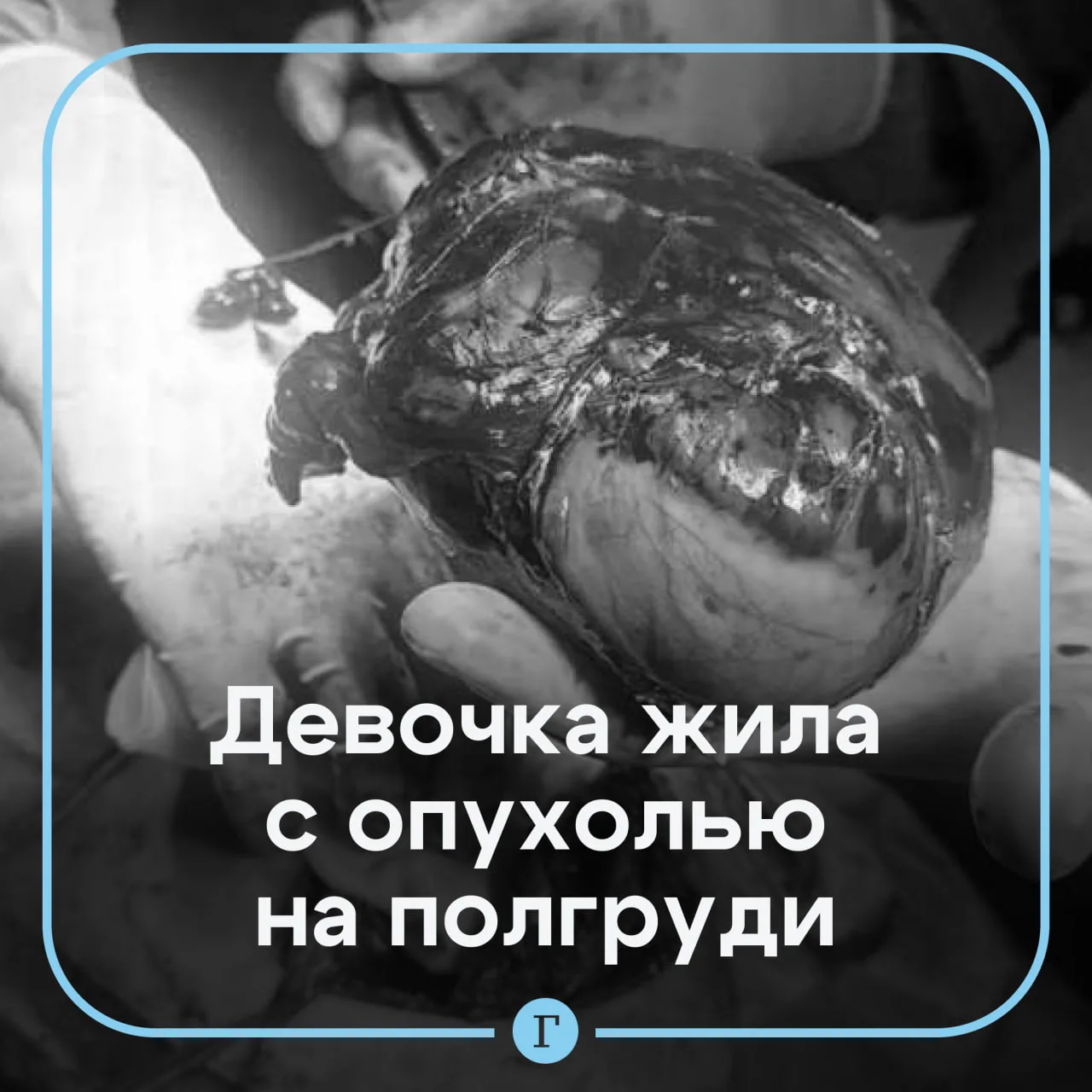 Врачи спасли девочку с гигантской опухолью в грудной клетке.

Новообразование вилочковой железы у ре
