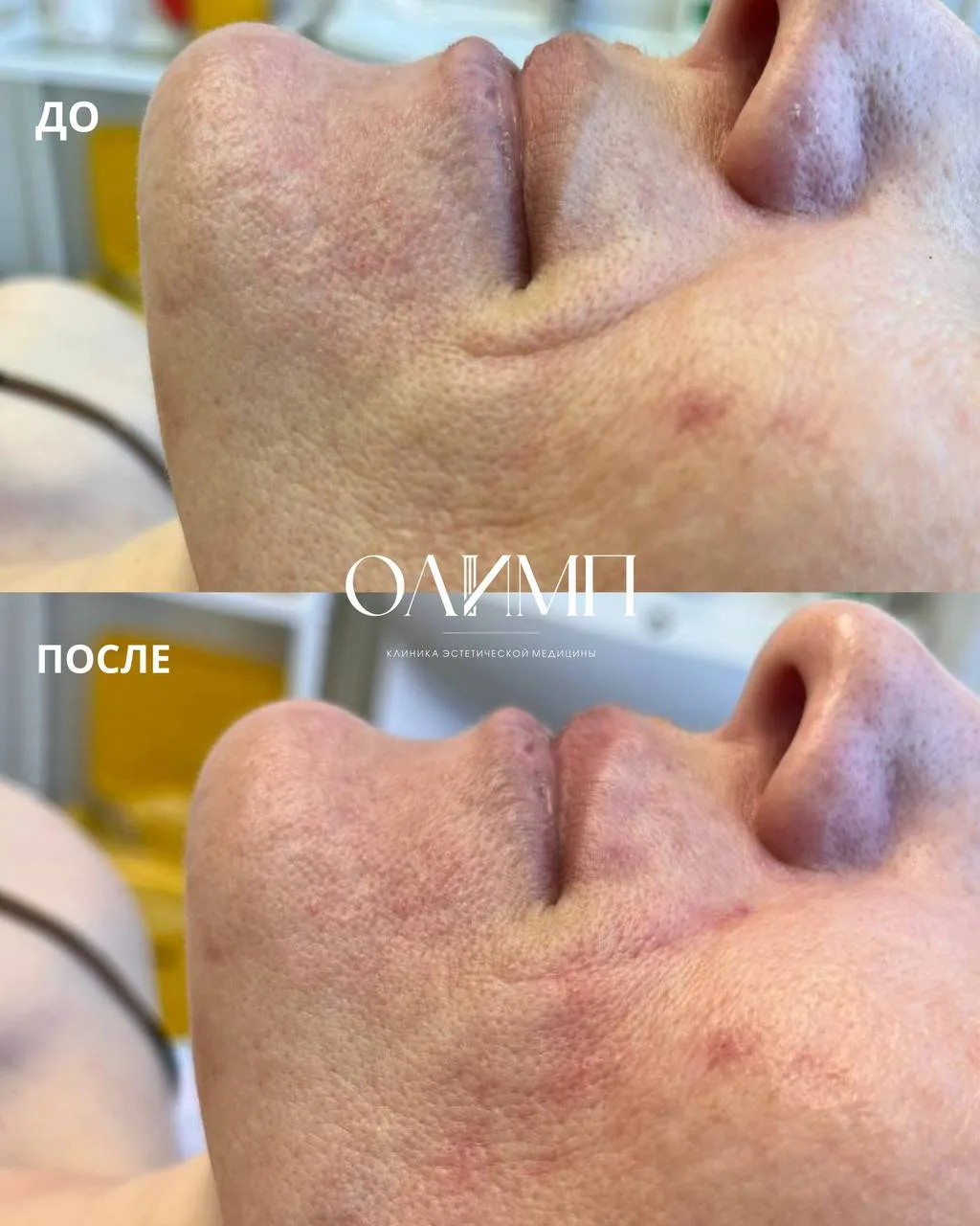 Было выполнено бланширование морщин улыбки 1 мл Belotero Soft.