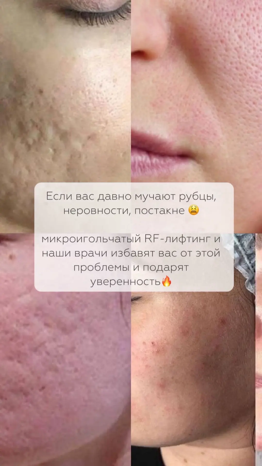 ✨В курсе  «Рубцы» ,мы собрали для вас необходимые процедуры,а так же профессиональный у...
