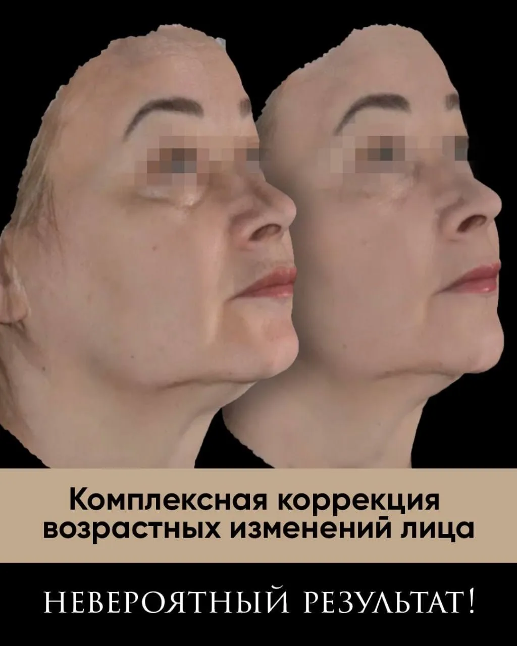 Кейс комплексной коррекции возрастных изменений лица у пациентки с запросом на естестве...