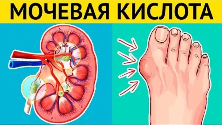 🔍 ПОЧЕМУ ПОВЫШАЕТСЯ МОЧЕВАЯ КИСЛОТА? Разбираем механизм на простом языке